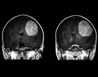 Gehirntumor Symptome Ursachen Und Behandlung Von Hirntumoren